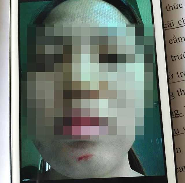 Một cô giáo bị xước nhẹ trong lúc va chạm với cô T. Ảnh: Gia Đình Xã Hội.