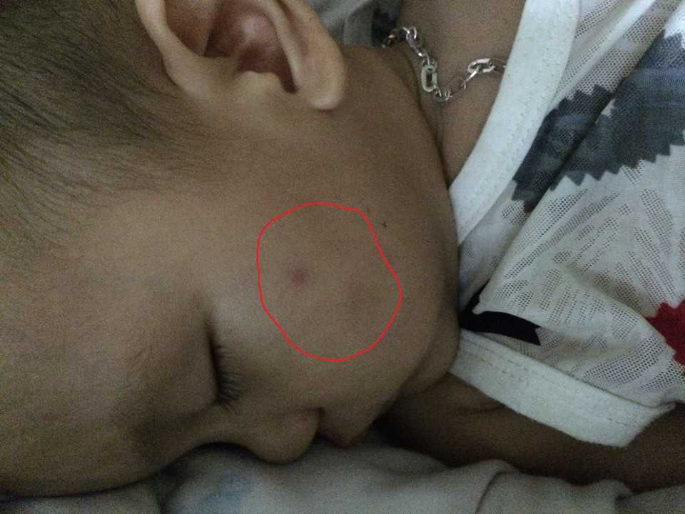 Trên cơ thể bé Long xuất hiện nhiều vết thâm tím sau khi đi học tại trường mầm non