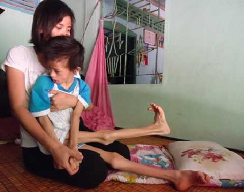 Nhật Lam co quắp tay chân, không thể tự chủ trong mọi sinh hoạt khi bị bại não.