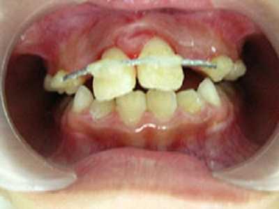 Răng bé được nắn chỉnh lại.