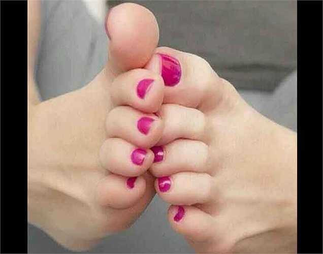 Móng chân lõm là một dấu hiệu của bệnh vẩy nến, bệnh về da gây ra bởi một hệ thống miễn dịch hoạt động quá mức. Bạn cần phải điều trị tình trạng với sự giúp đỡ của thuốc kem bôi. Với tình trạng này, chân của bạn bị viêm và phát triển các mảng trắng.