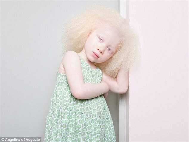 Do thị lực suy giảm nên việc lái xe là vấn đề gây trở ngại nhất đối với người bị bạch tạng.