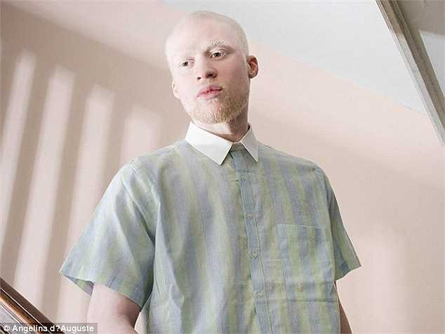 'Căn bệnh khiến tôi phải thường xuyên ở trong nhà và không dám ra ngoài', một người mắc bệnh bạch tạng chia sẻ với tác giả bộ ảnh.