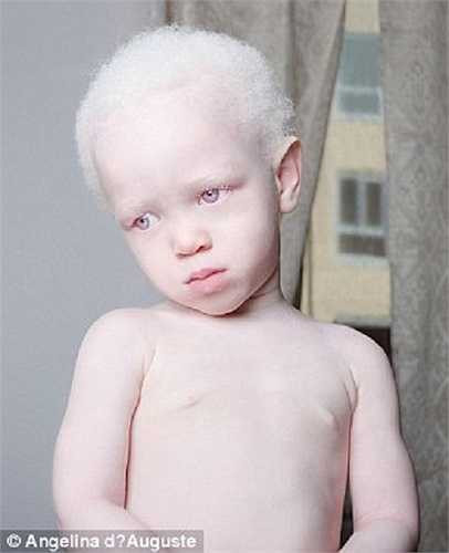 Bộ ảnh có sự góp mặt của các bệnh nhân mắc bạch tạng ở mọi lứa tuổi.