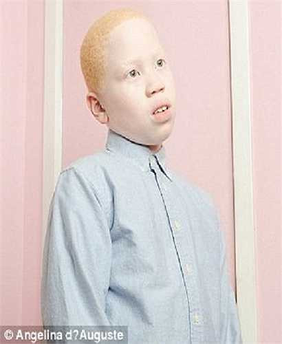 Hình ảnh một cậu bé mắc bệnh bạch tạng với khuôn mặt đáng thương được thể hiện rõ nét.