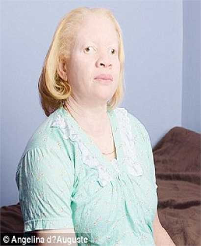 Bạch tạng là một thuật ngữ dùng chung cho các chứng bẩm sinh do rối loạn quá trình sinh tổng hợp ra sắc tố melanin, làm cho da, tóc và mắt của người bệnh có màu nhạt.