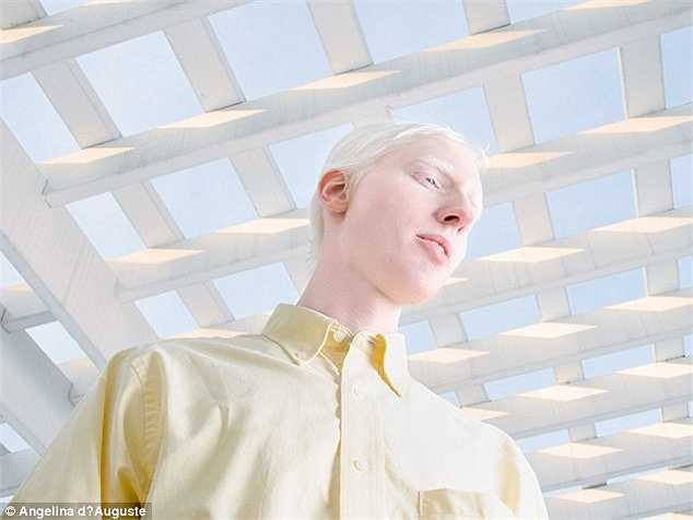 Ở Mỹ, trung bình cứ khoảng 18.000 - 20.000 người thì có một người mắc bệnh bạch tạng.