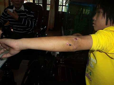 Cánh tay cháu bé có nhiều vết sẹo, máu đã khô và đóng vẩy. Ảnh: Sơn Dương Cánh tay cháu bé có nhiều vết sẹo, máu đã khô và đóng vẩy. Ảnh: Sơn Dương