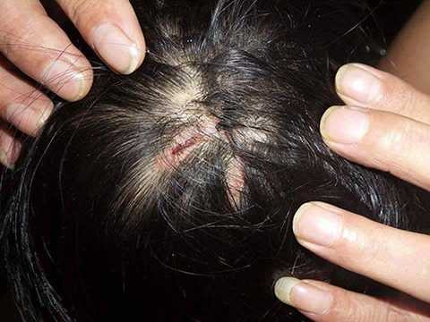 Trên đỉnh đầu bé gái có nhiều vết sẹo, có vết đã khô lại và có vết vẫn còn dính máu. Ảnh: Sơn Dương Trên đỉnh đầu bé gái có nhiều vết sẹo, có vết đã khô lại và có vết vẫn còn dính máu. Ảnh: Sơn Dương