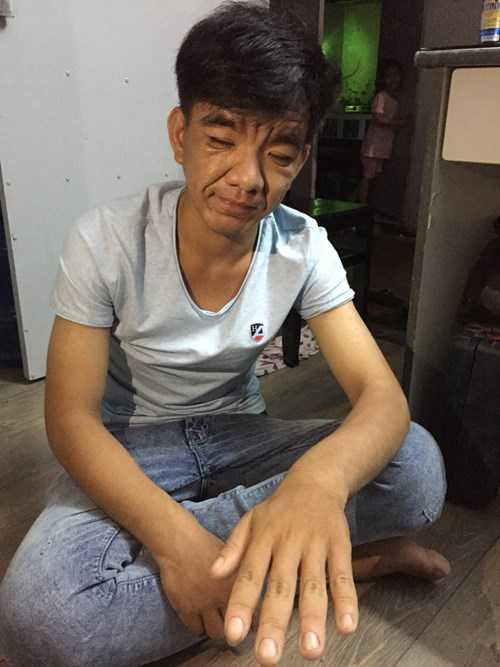 Những ngón tay to bất thường