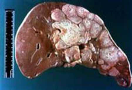 Gặp các giáo sư đầu ngành về ung thư