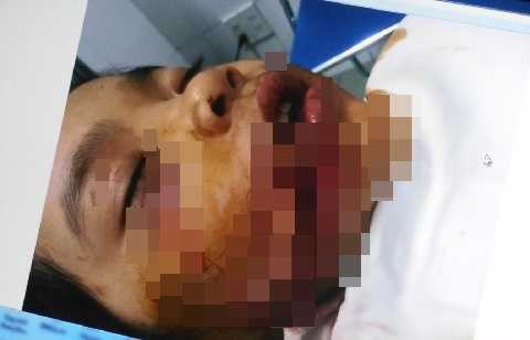 Bé T. bị chó nhà cào, cắn với vết thương kinh hoàng. Ảnh: Phi Long Bé T. bị chó nhà cào, cắn với vết thương kinh hoàng. Ảnh: Phi Long