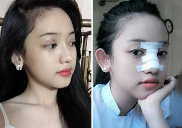 Có ai nghĩ được cô gái 17 tuổi dám công khai những hình ảnh phẫu thuật thẩm mỹ như thế này?
