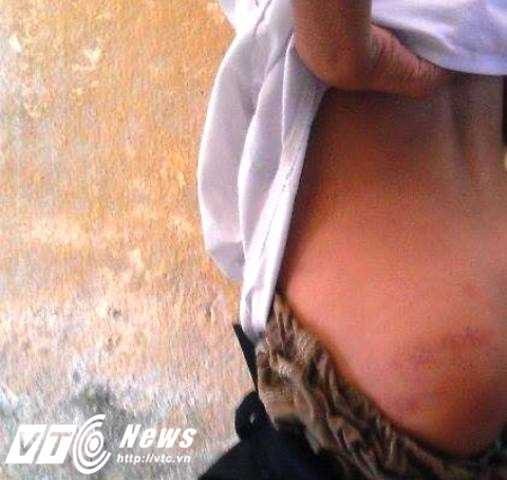 Hơn chục học sinh lớp 2/1 Trường Tiểu học Thuận Hòa bị cô giáo Thảo dùng thước gỗ đánh bầm dập vùng mông.