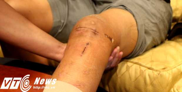 Vết thương của Anh Khoa sau phẫu thuật (Ảnh: Quang Minh)