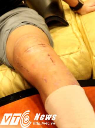 Trên vết thương vẫn còn dấu đinh giày của 'tác giả' gây ra vụ việc (Ảnh: Quang Minh)