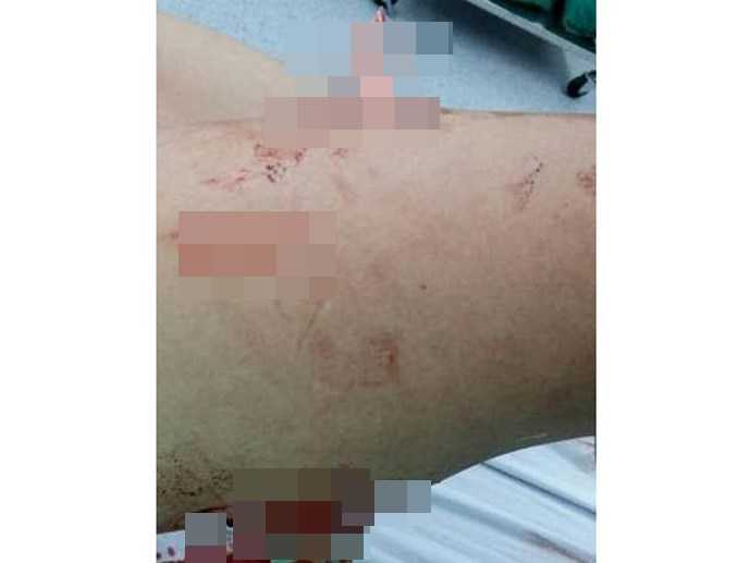 Vết thương trên đùi anh Phương 