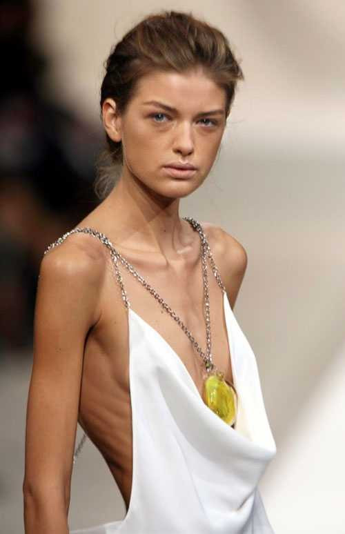 Ana Carolina Reston chết khi mới 22 tuổi với thân hình chỉ nặng vỏn vẹn 39 kg và cao tận 1m72