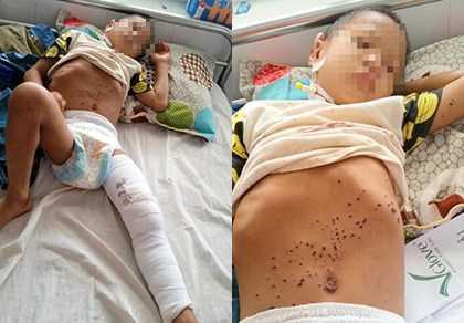 Cháu Nhảy bị thương nặng khi chơi kíp nổ do cha nhặt về .