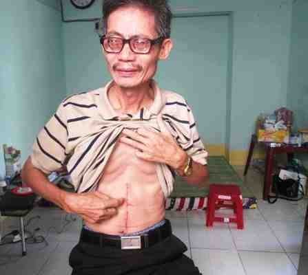 Ông Sáu chỉ vết thương vì bị con ruột đâm.