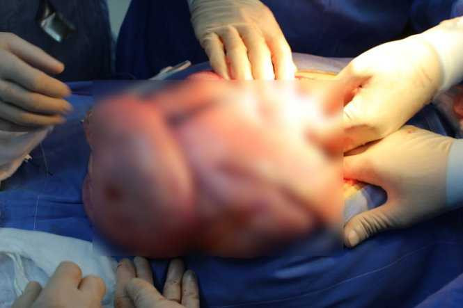 Những cục u lấy ra từ bụng bệnh nhân L.T.N.