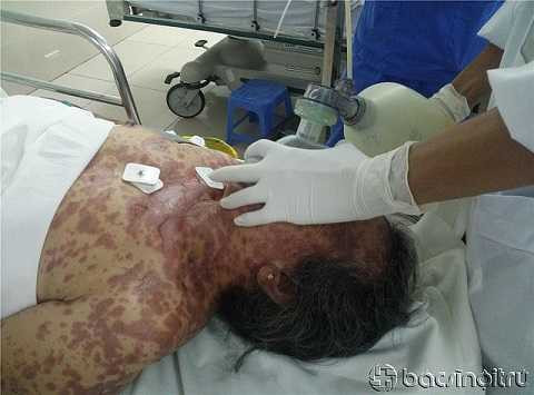 Bệnh nhân bị hoại tử