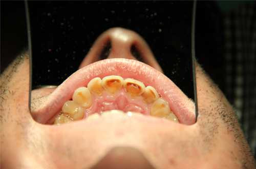 Nuốt nhầm kẹo cao su liệu có bị tắc ruột?