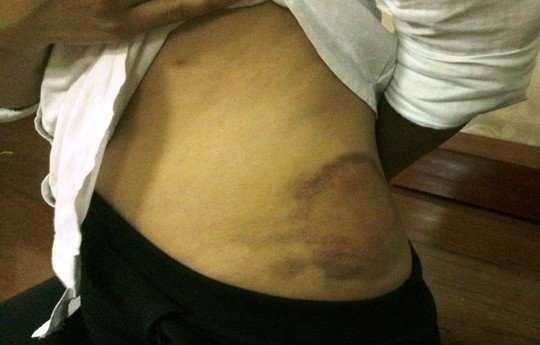 Những vết thâm trên người mà Nguyễn Thị Linh Trang nói do bị mẹ con bà Vân đánh.