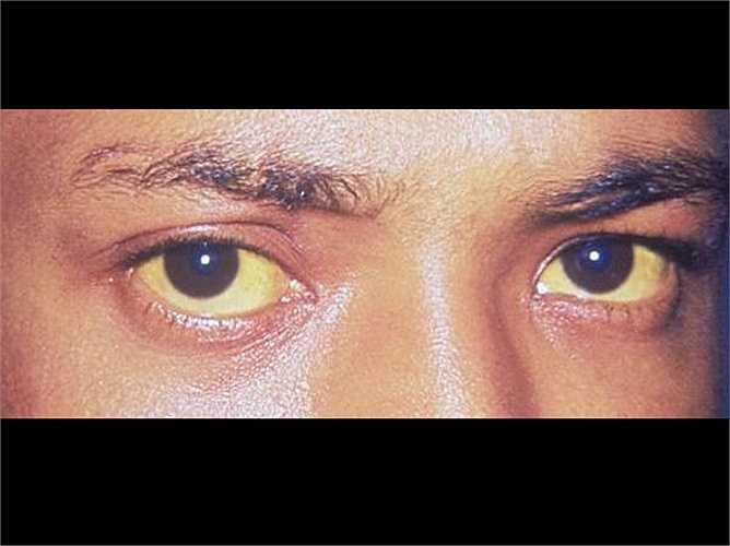 Sốt vàng da là một bệnh phổ biến trong mùa mưa. Để tránh căn bệnh chết người này, bạn nên chỉ uống nước đun sôi và nên tránh thức ăn đường phố. Rau củ cũng nên rửa sạch bằng nước muối trước khi nấu để diệt vi trùng có hại. 