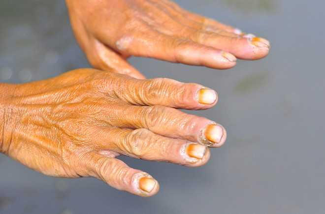 Ngâm mình dưới nước bẩn suốt nhiều giờ nên hầu hết người hành nghề này bị lở loét, ngứa, bệnh thấp khớp... Theo ngư dân, họ thường xuyên bị rách da, chảy máu do đạp trúng mảnh vỡ thủy tinh. 