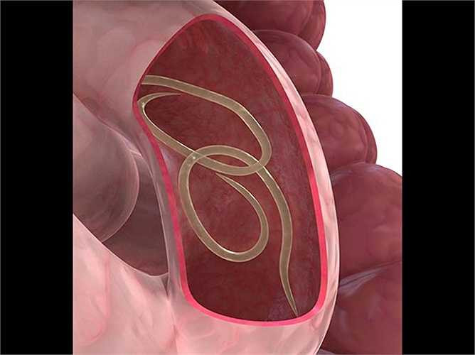 Ký sinh trùng xâm nhập vào cơ thể bằng cách nào? Khi tiếp xúc với phân bị nhiễm bệnh có thể bị lây nhiễm. Phân nhiễm bệnh có thể có trong thực phẩm, nước và đất. Nguyên nhân là do vệ sinh kém, tham quan khu vực bị nhiễm bệnh hoặc có hệ thống miễn dịch yếu. 