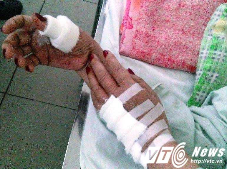 Bà L.T.H đã được các bác sĩ tiến hành nối ngón và gân tay và hiện vẫn đang điều trị tại bệnh viện.