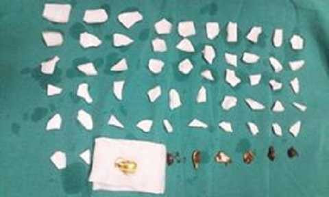 Mảnh bát vỡ lấy từ bụng bệnh nhân. Ảnh: Bác sỹ cung cấp