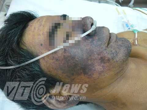 10 người chết do sử dụng thịt lợn không đúng cách