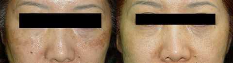 Hiệu quả trị nám và thu nhỏ lỗ chân lông, cải thiện da nhờ sau 2 lần điều trị