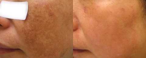 Kết quả điều trị nám sau 18 ngày: liệu trình 1 ngày/lần trong 1 tuần, sau đó 3 ngày/lần