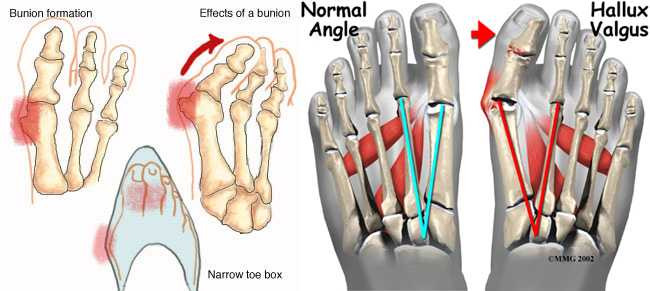 Loại bỏ u biến dạng ở khớp ngón chân cái