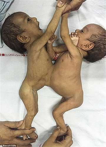 Các bác sỹ tại Ấn Độ vừa thực hiện thành công ca phẫu thuật tách rời cho cặp song sinh 3 tháng tuổi. Được biết hai bé dính liền và chia sẻ với nhau lá gan.