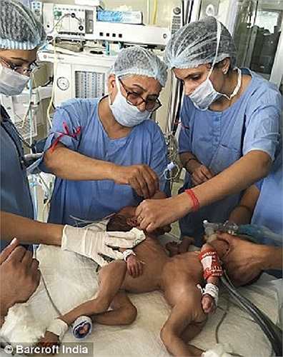 Bác sỹ Ravi Kanojia - Giáo sư y khoa và là người trực tiếp điều hành ca phẫu thuật cho biết: 'Đây là một ca dính liền hiếm gặp, chỉ xảy ra ở tỷ lệ 1/1 triệu bé. Tôi thật sự may mắn khi là người thực hiện ca tách rời này'.