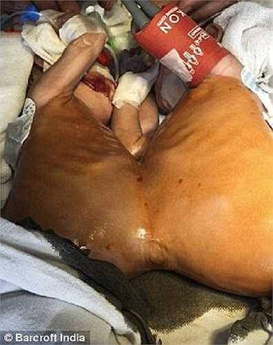 Ca phẫu thuật kéo dài 8 tiếng được thực hiện vào hôm 23/11 vừa qua với sự tham gia của hơn 30 y bác sỹ.