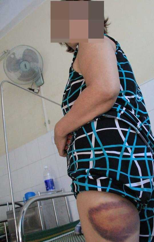 Bà Khả bị đánh bầm tím bắp đùi và mông
