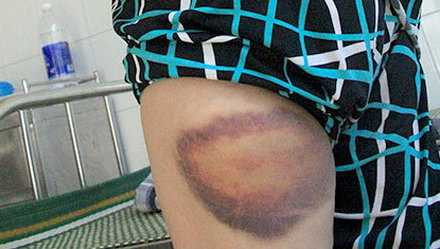 Vết thương bầm tím trên người bà Khả