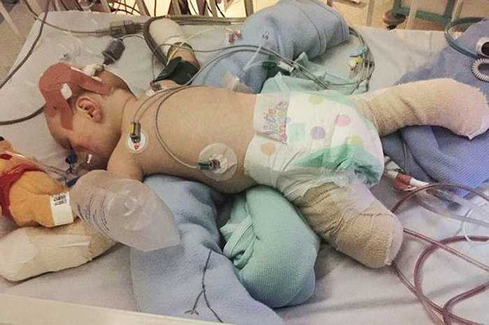 May mắn sống sót nhưng do di chứng của căn bệnh nên cậu bé Taylor đã phải cắt bỏ một phần chân trái, các ngón chân phải và toàn bộ 10 ngón tay. 