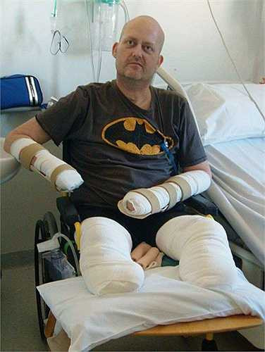 Anh John Rushton, 42 tuổi, một người quản lý bưu điện ở Anh bị viêm phổi sau khi mắc bệnh cảm lạnh. Nhưng tình trạng của anh đã tồi tệ hơn khi nằm trong bệnh viện. Bác sĩ đã chuẩn đoán rằng anh bị mắc chứng nhiễm trùng máu và buộc phải cắt bỏ bàn tay phải, các ngón tay trên bàn tay trái và cả hai chân của anh. 