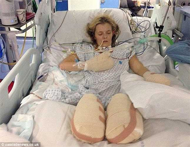 Tracy Ralph, 34 tuổi, ở Anh là một vận động viên điền kinh. Trong khi tập luyện chuẩn bị cho cuộc thi marathon, cô cảm thấy khó thở. Sau đó, cô được bác sĩ chẩn đoán bị viêm phổi. Sau vài ngày, Tracy hôn mê. Cô được đưa vào bệnh viện trong tình trạng suy đa tạng, viêm màng não, nhiễm khuẩn máu, đông máu và chảy máu não. 