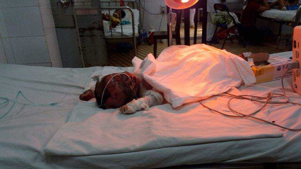 Bé Ai Dưm bị bỏng nặng 