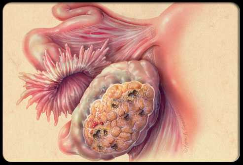 Ung thư buồng trứng.