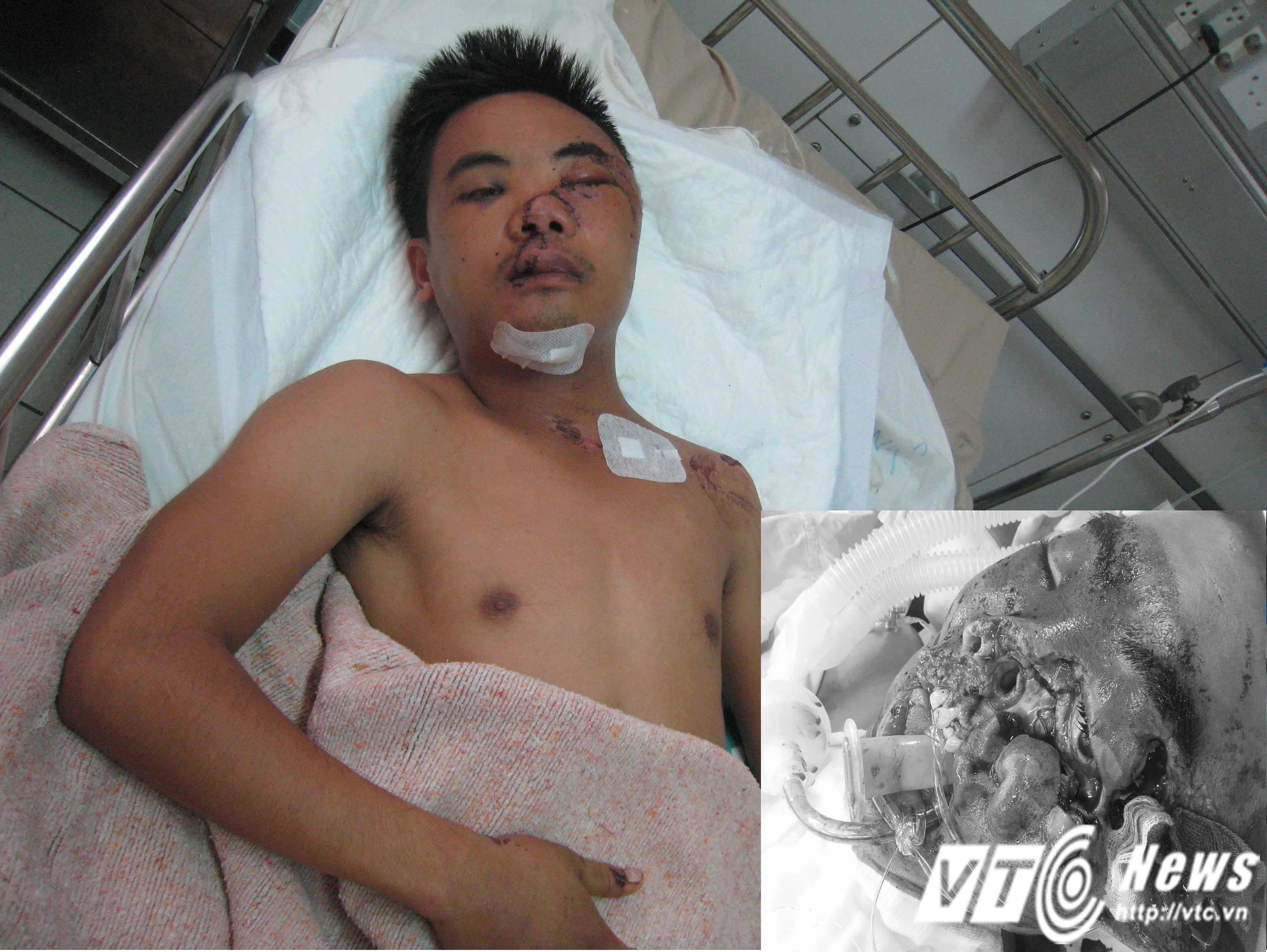 Tình trạng bệnh nhên sau và trước khi(ảnh nhỏ) được phẫu thuật.