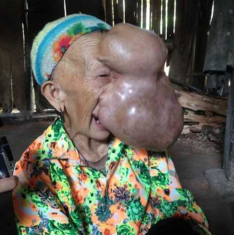 Bà Chài trước khi mổ.