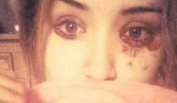 Marnie Harvie mắc bệnh lạ chảy máu mắt, tai 5 lần mỗi ngày Marnie Harvie mắc bệnh lạ chảy máu mắt, tai 5 lần mỗi ngày